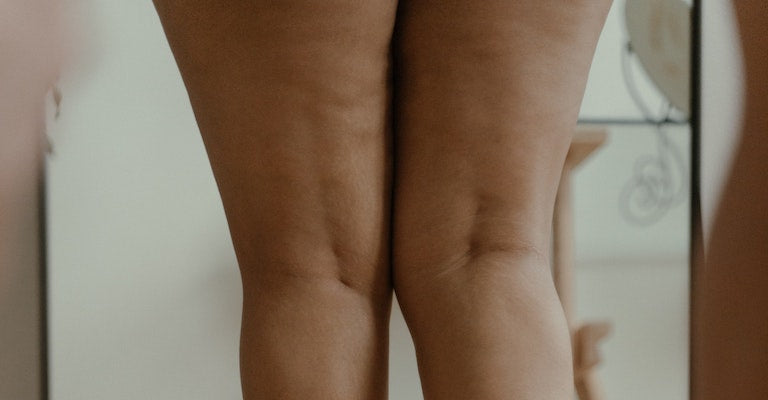 Inner Thigh Chafing: Causes and Ways to Treat It – Thigh Society Inc