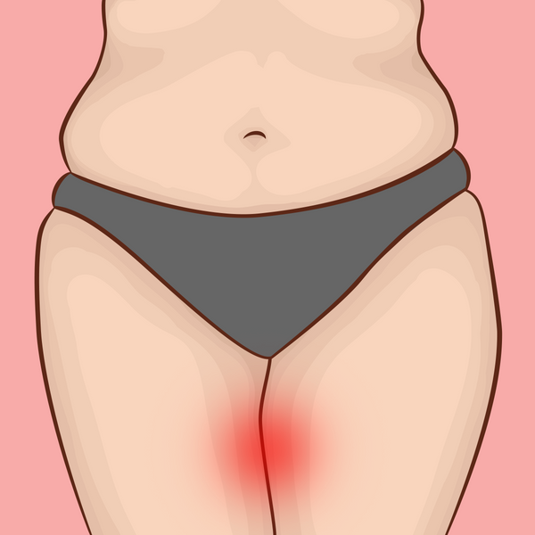 How to Care for Chafed Inner Thighs